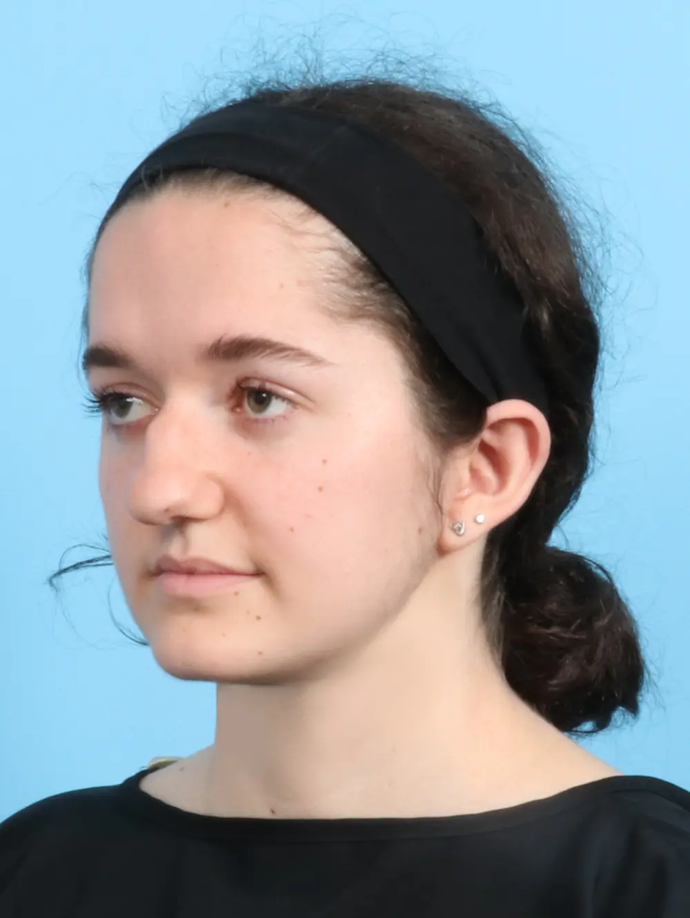 Rhinoplasty Patient Photo - Case 21892 - before view-2