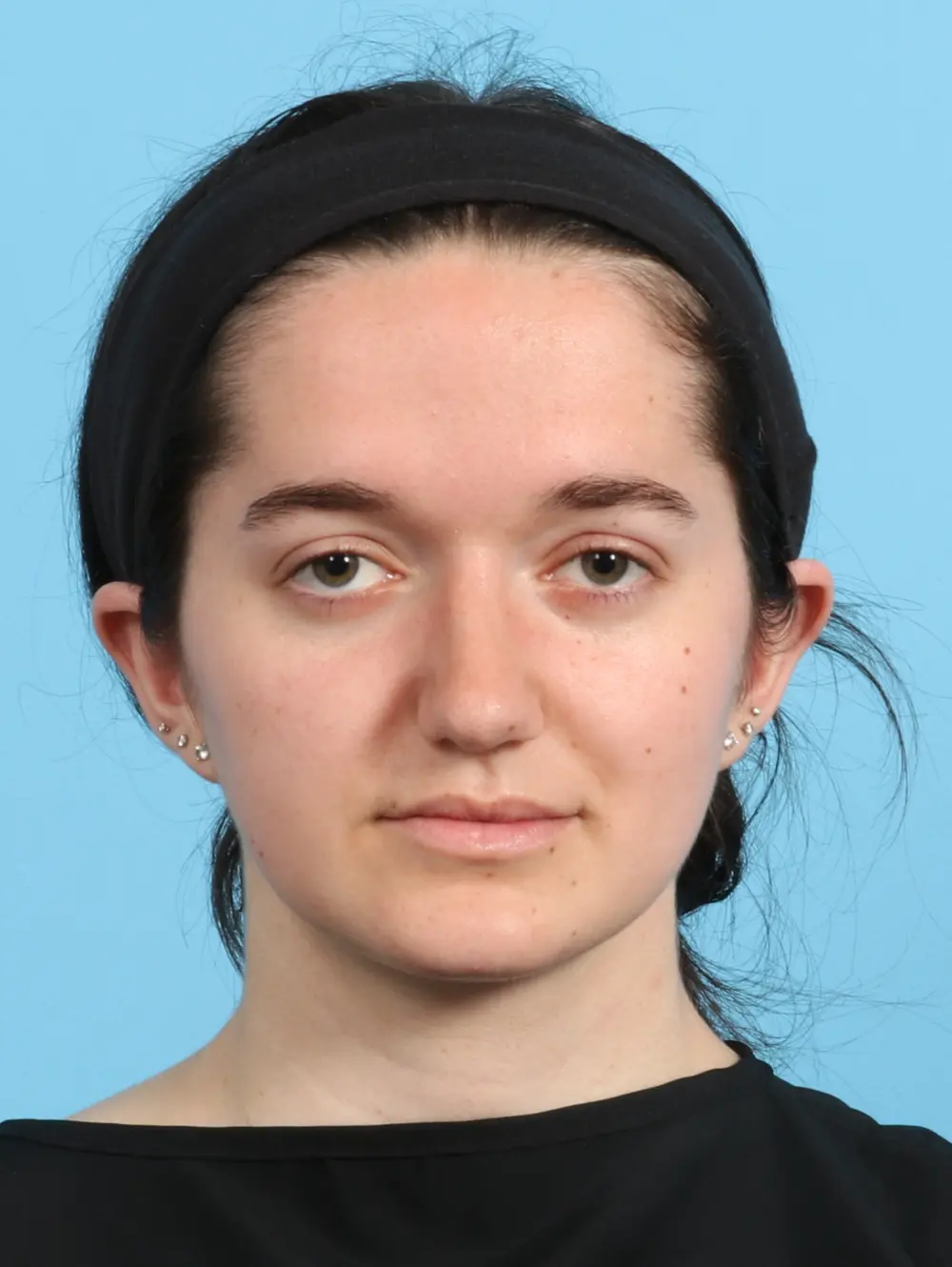Rhinoplasty Patient Photo - Case 21892 - after view-1
