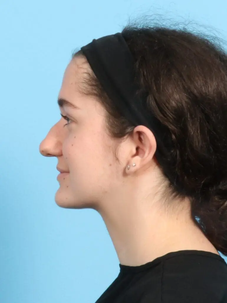 Rhinoplasty - Case 21892 - Before