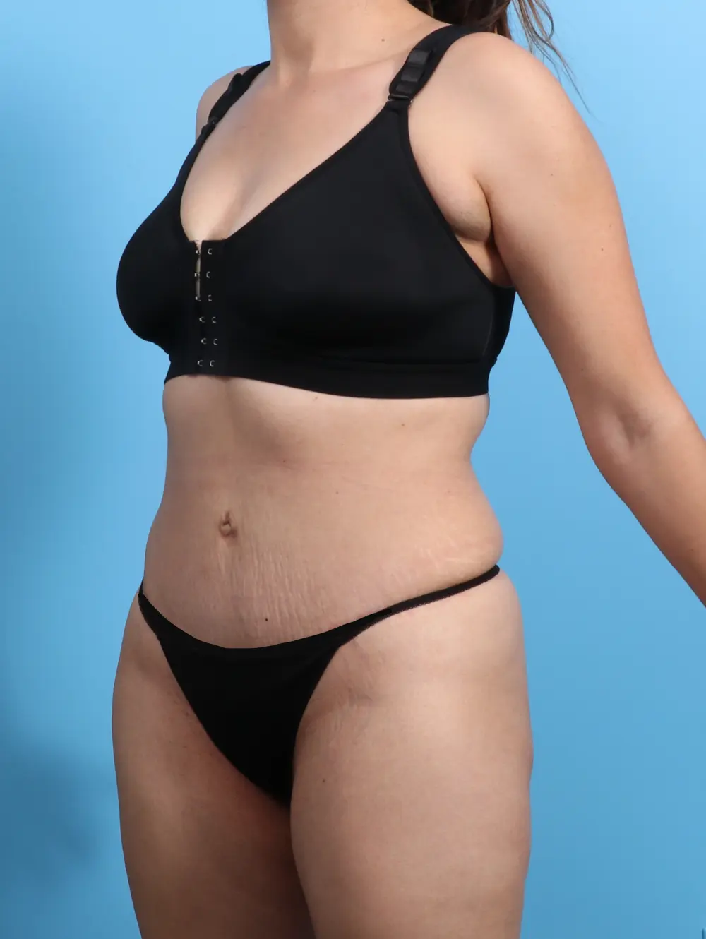Tummy Tuck Patient Photo - Case 21900 - after view-1