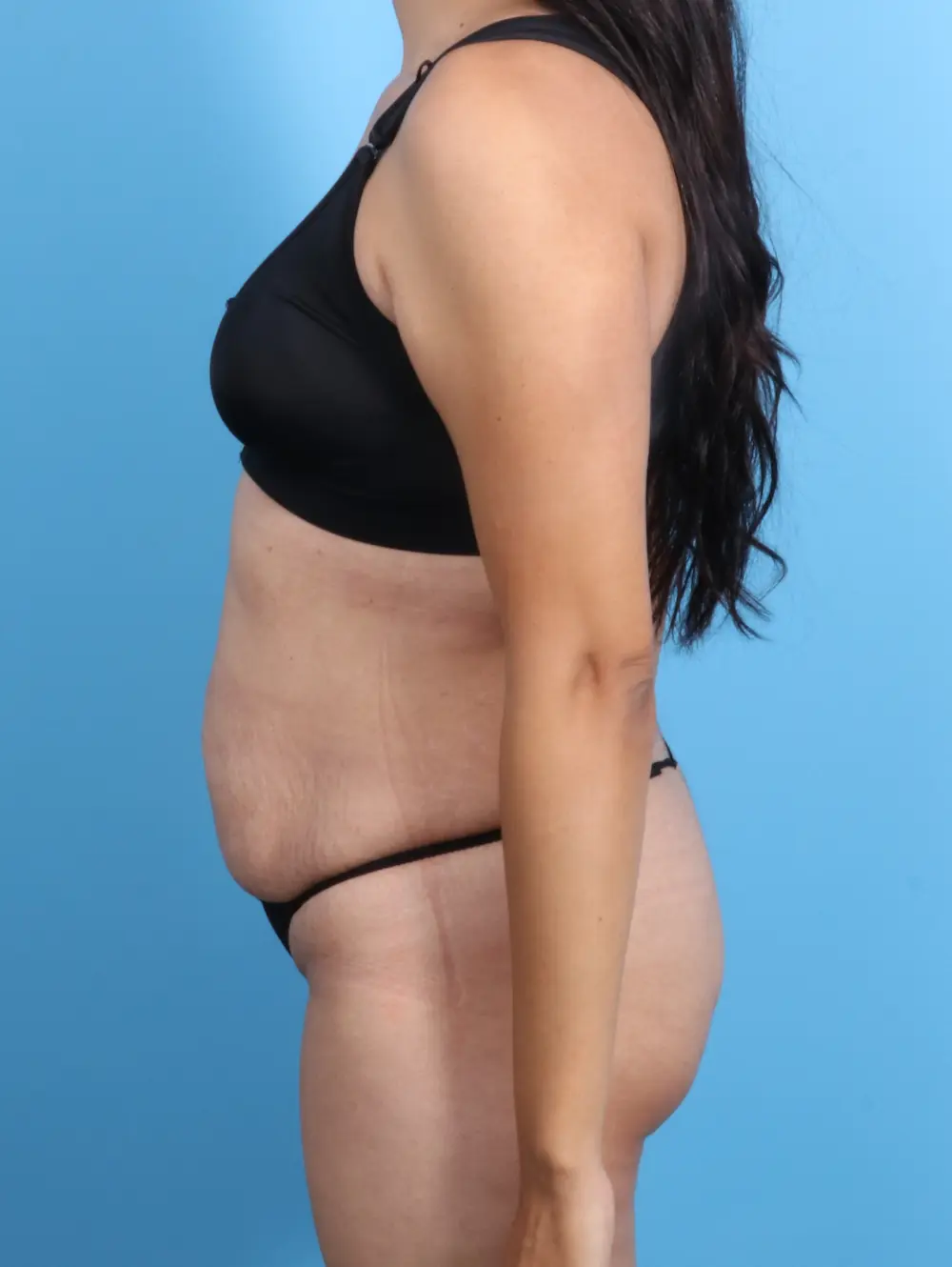 Tummy Tuck Patient Photo - Case 21900 - before view-2