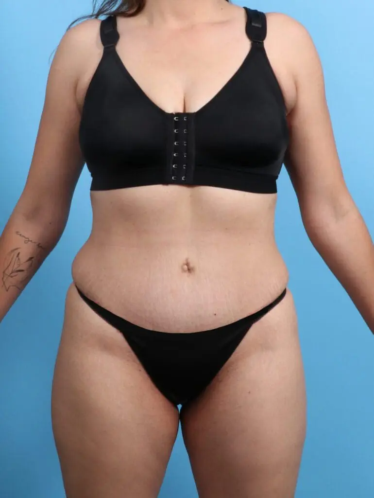 Tummy Tuck - Case 21900 - After