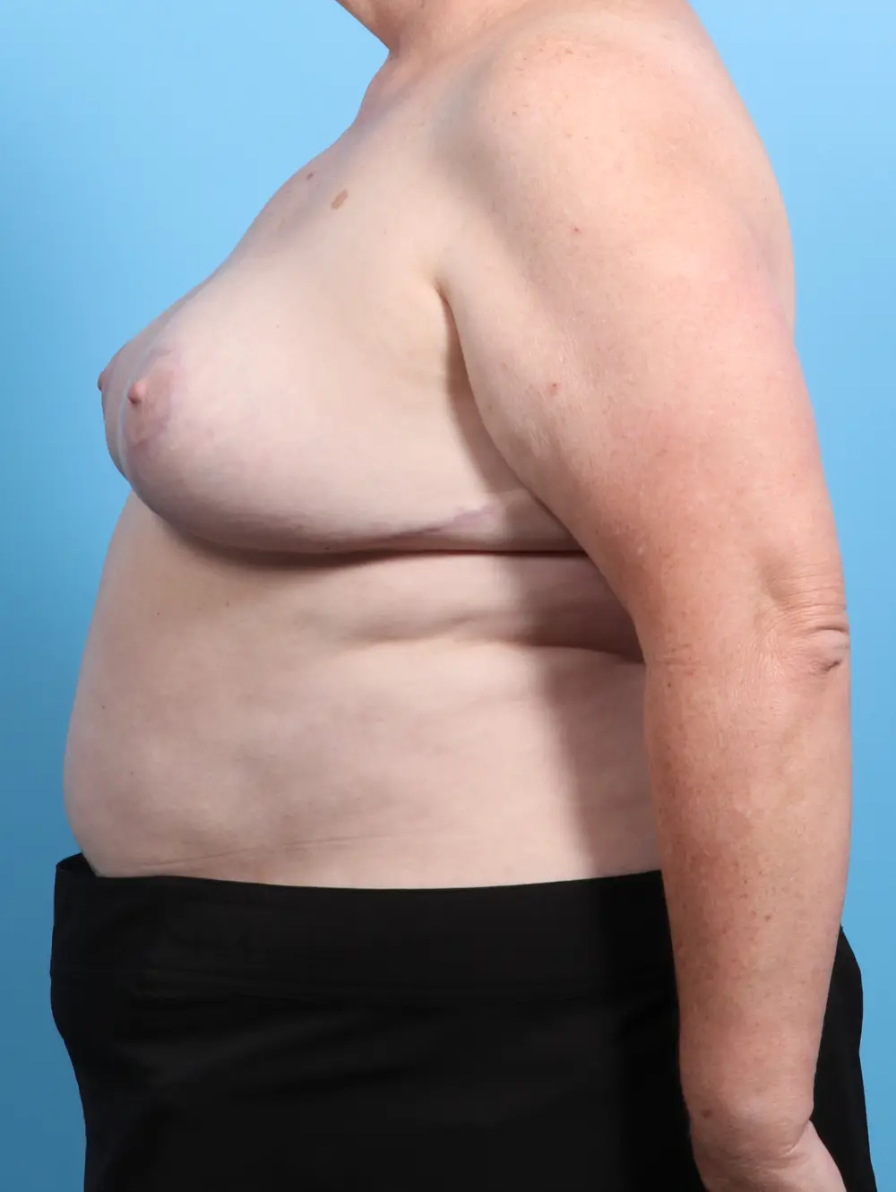 Breast Lift/Reduction w/o Implants Patient Photo - Case 21908 - after view-2