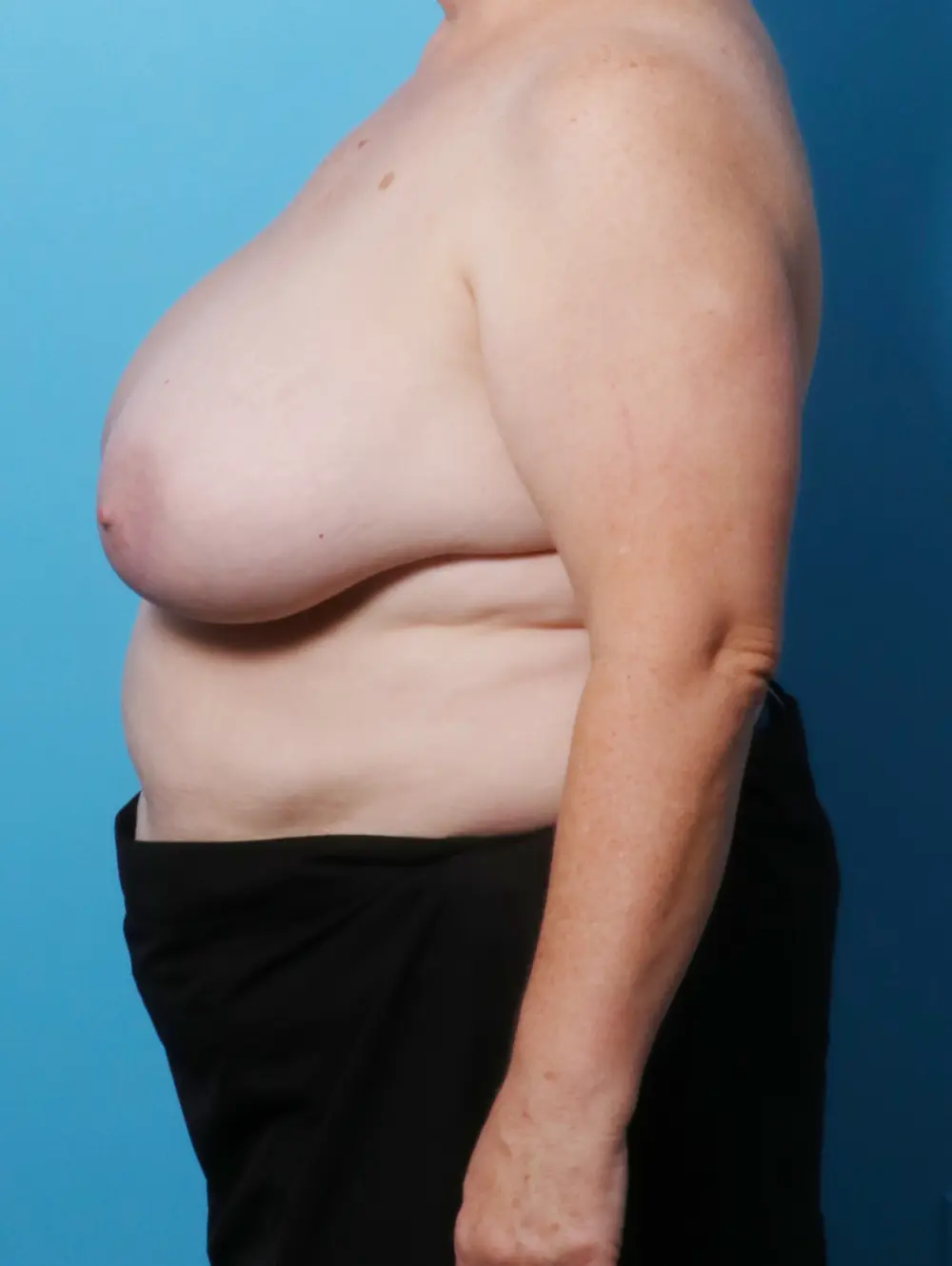 Breast Lift/Reduction w/o Implants Patient Photo - Case 21908 - before view-2