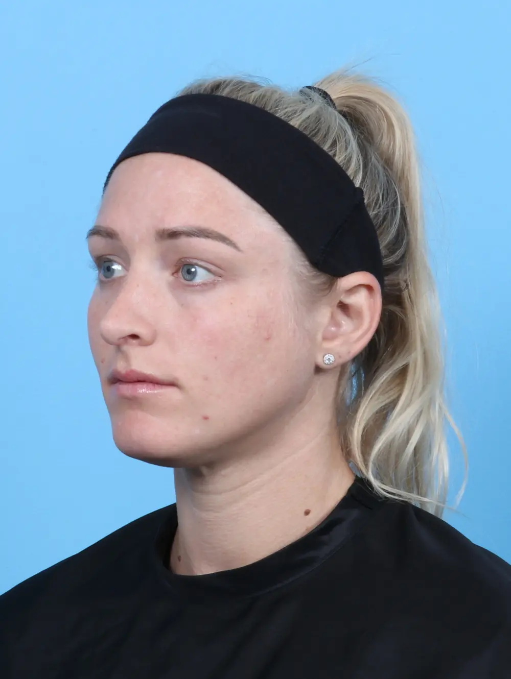 Rhinoplasty Patient Photo - Case 21370 - after view-1