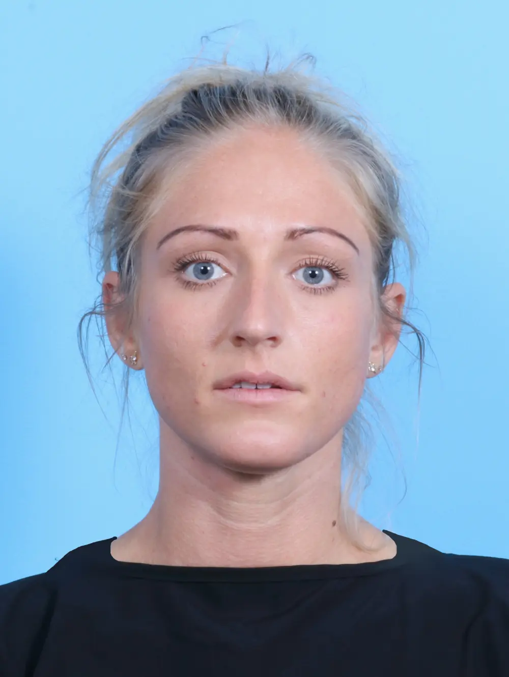 Rhinoplasty Patient Photo - Case 21370 - before view-2