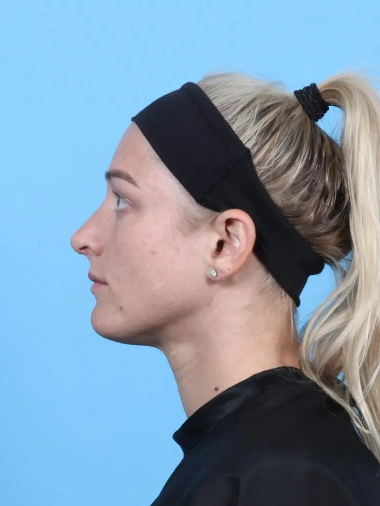 Rhinoplasty - Case 21370 - After