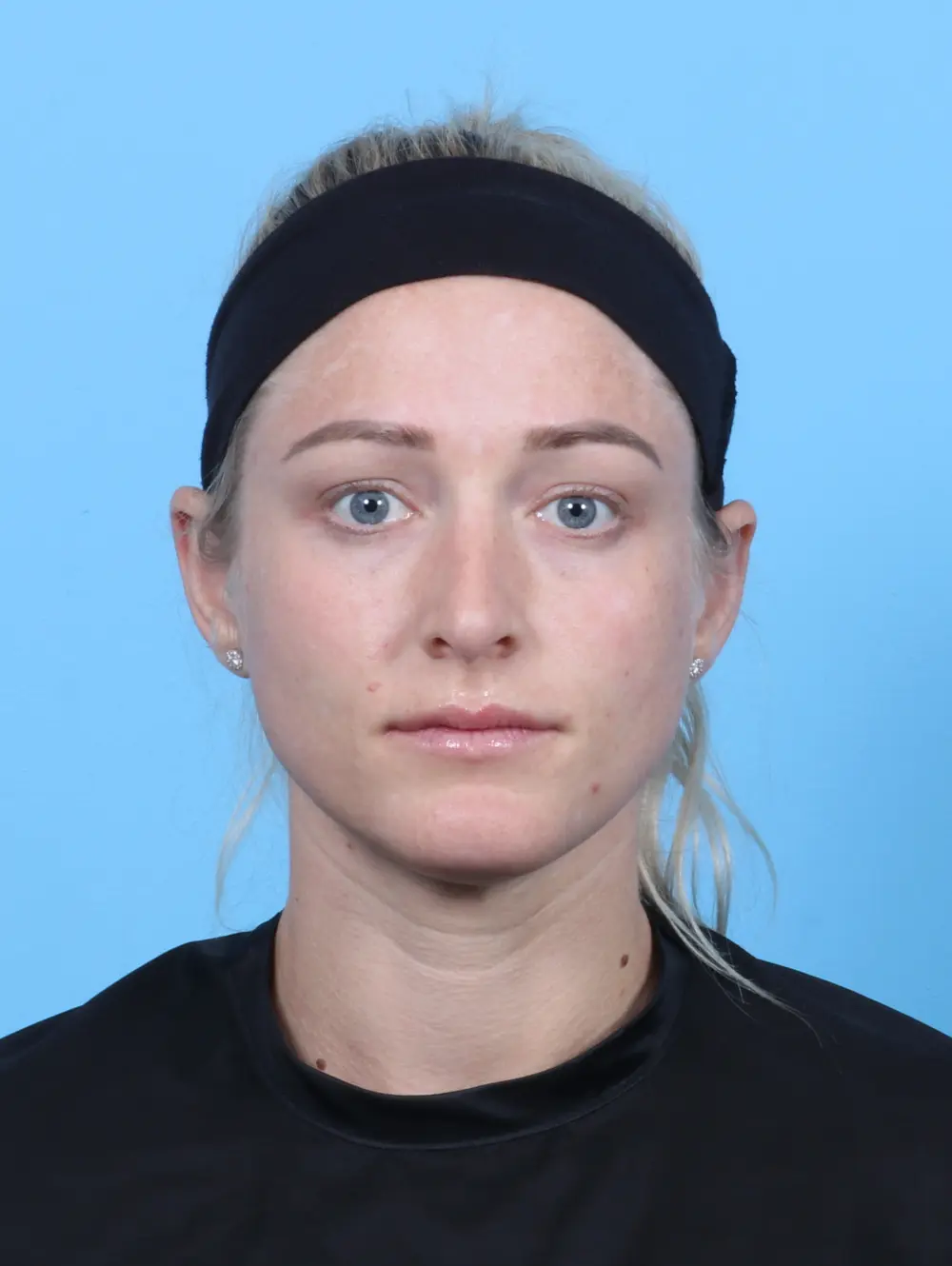Rhinoplasty Patient Photo - Case 21370 - after view-2