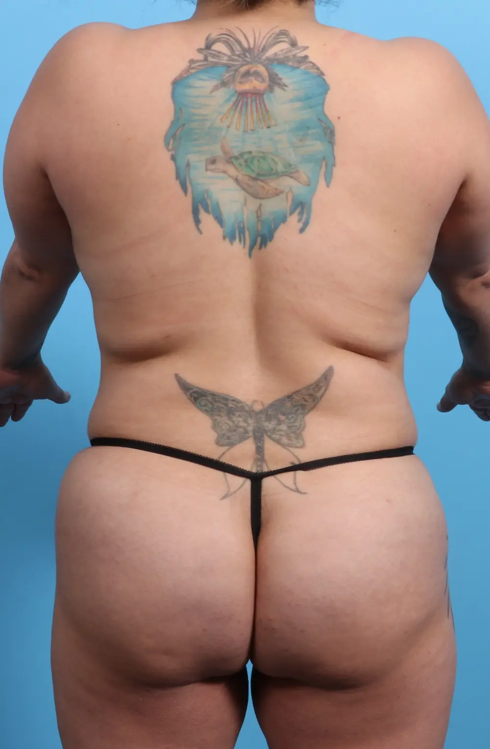 Breast Lift/Reduction with Implants Patient Photo - Case 21984 - after view-3