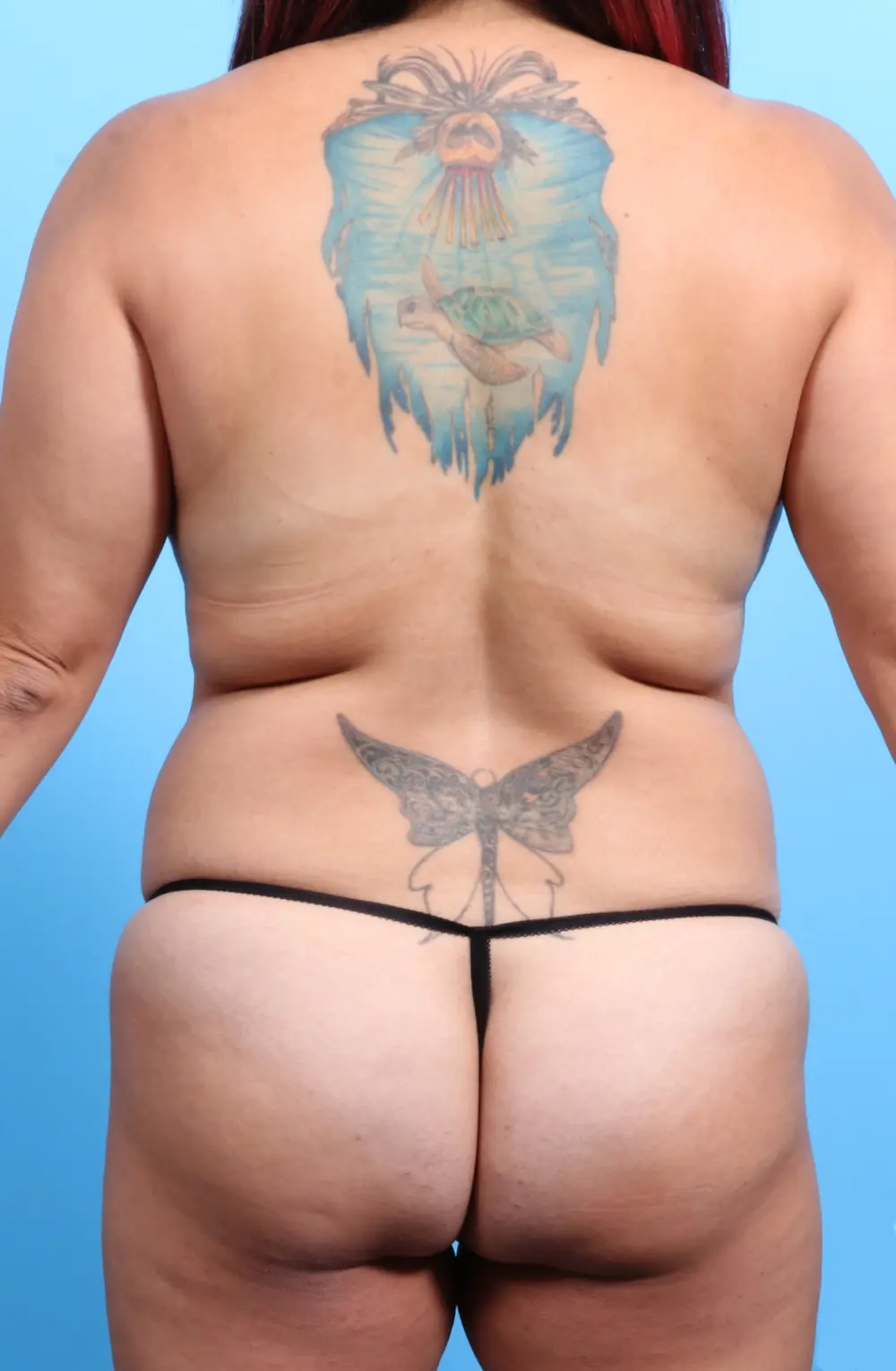 Breast Lift/Reduction with Implants Patient Photo - Case 21984 - before view-3