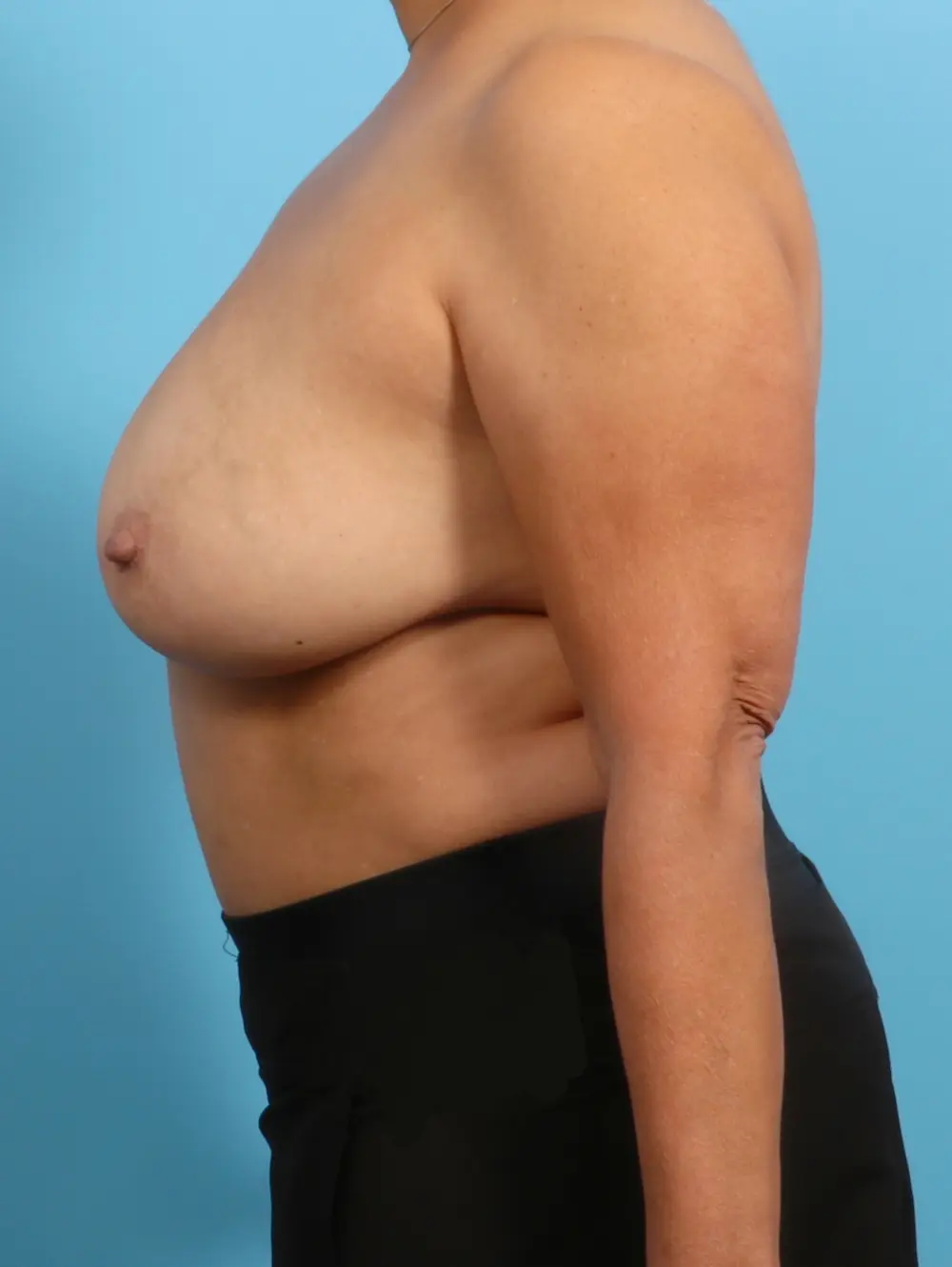 Breast Implant Removal Patient Photo - Case 21994 - after view-2