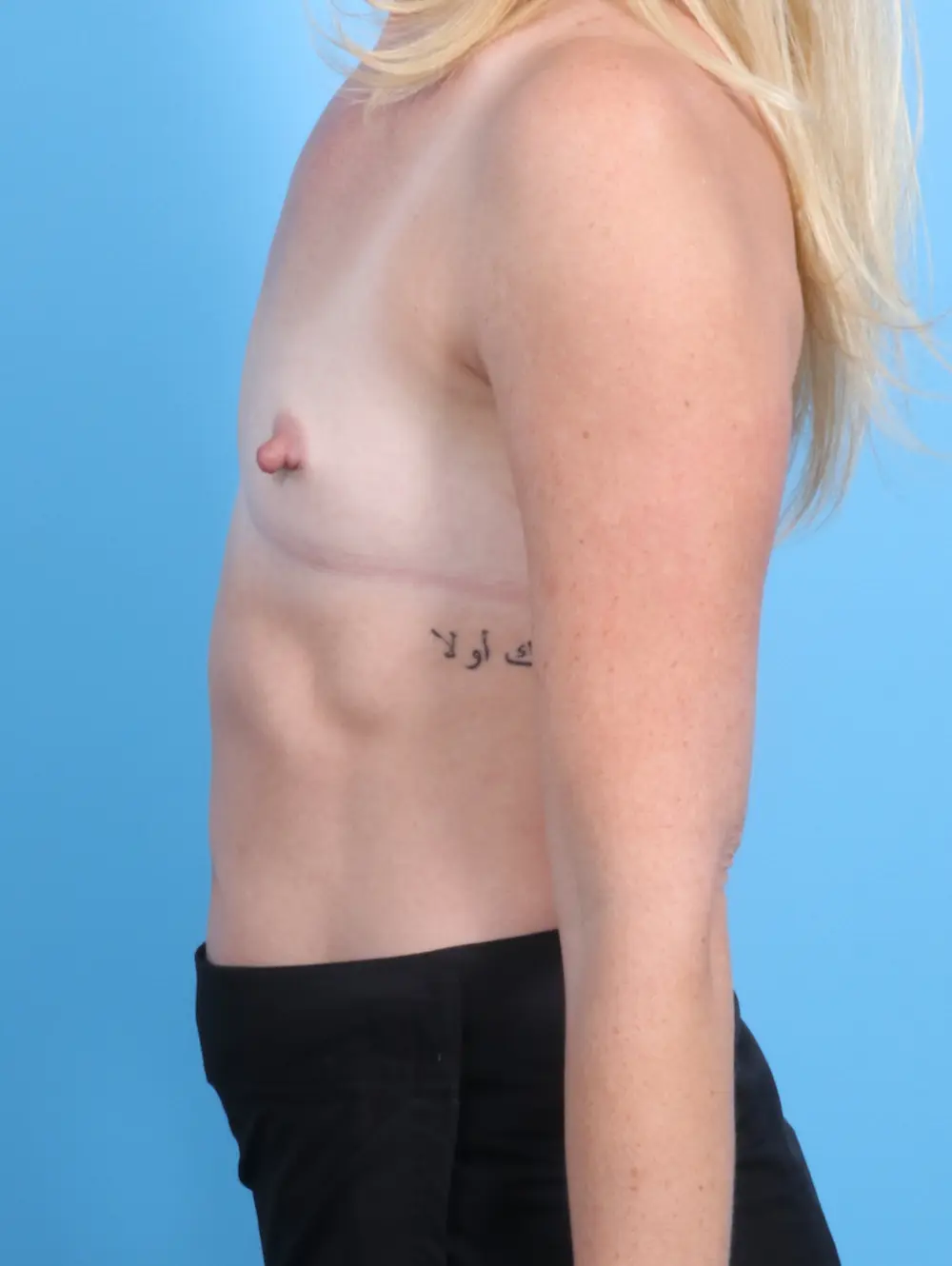 Breast Augmentation Patient Photo - Case 22022 - before view-2