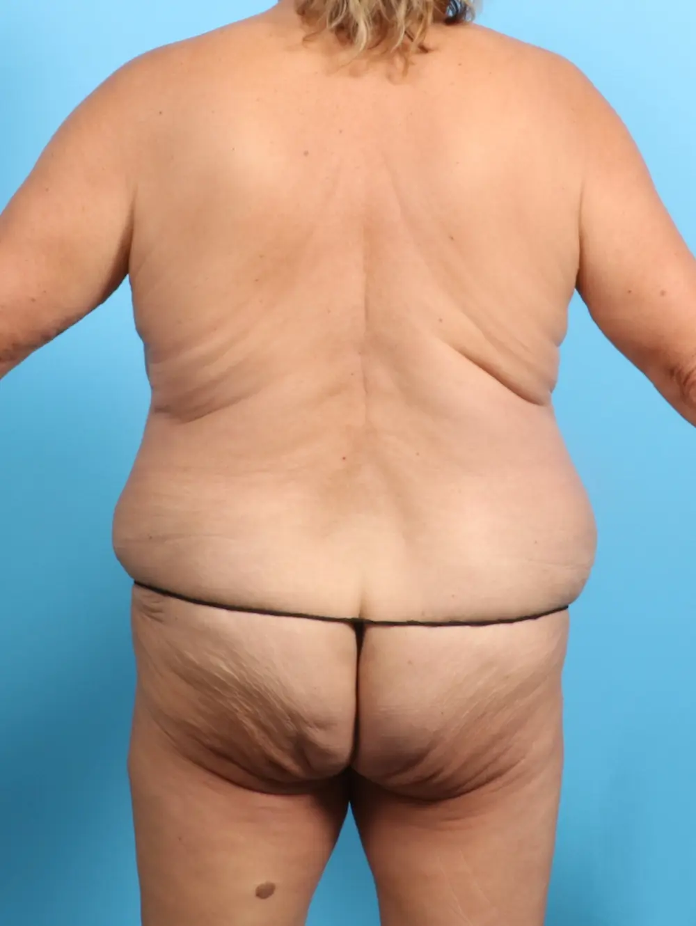 Body Lift Patient Photo - Case 22031 - before view-3