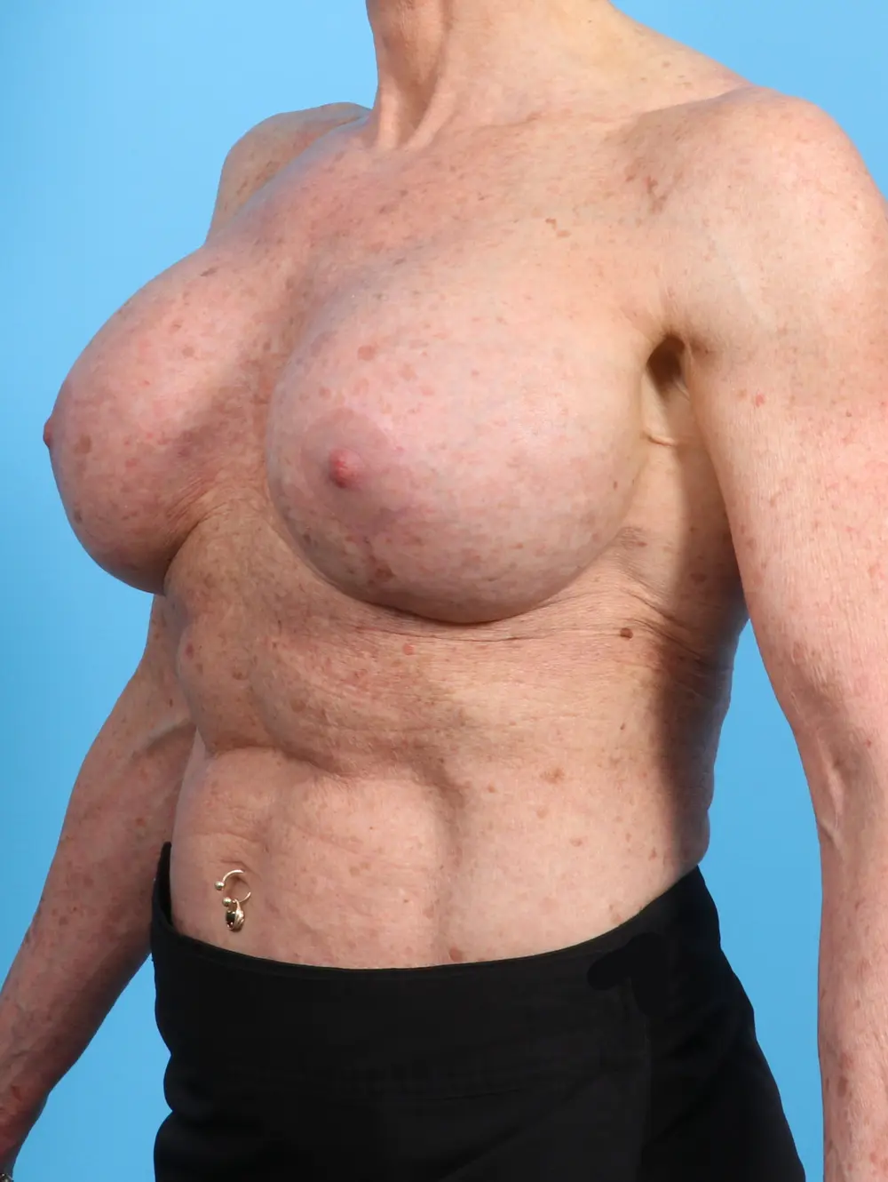 Breast Implant Revision Patient Photo - Case 22069 - after view-1