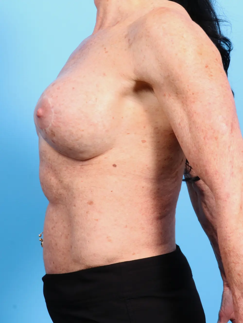 Breast Implant Revision Patient Photo - Case 22069 - before view-2