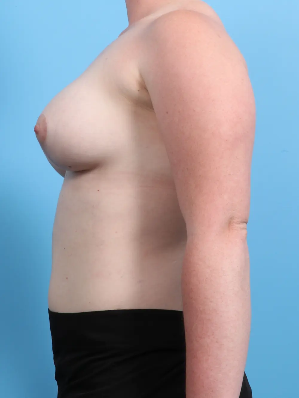Breast Lift/Reduction with Implants Patient Photo - Case 22123 - after view-2