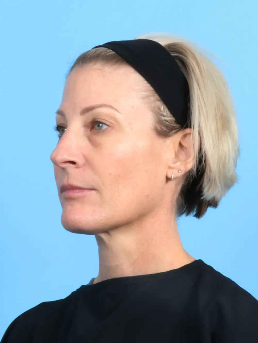 Eyelid Surgery Patient Photo - Case 22131 - before view-1