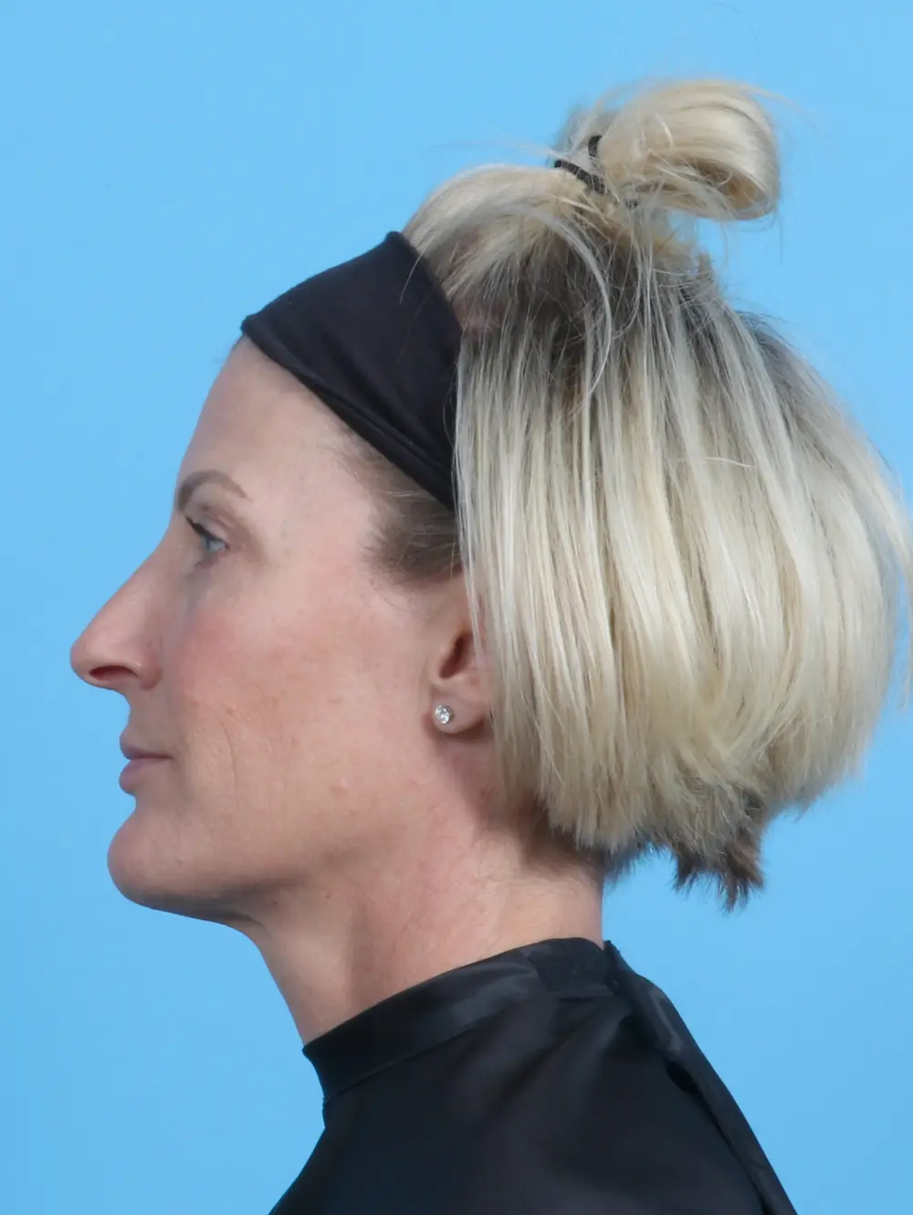 Eyelid Surgery Patient Photo - Case 22131 - after view-2