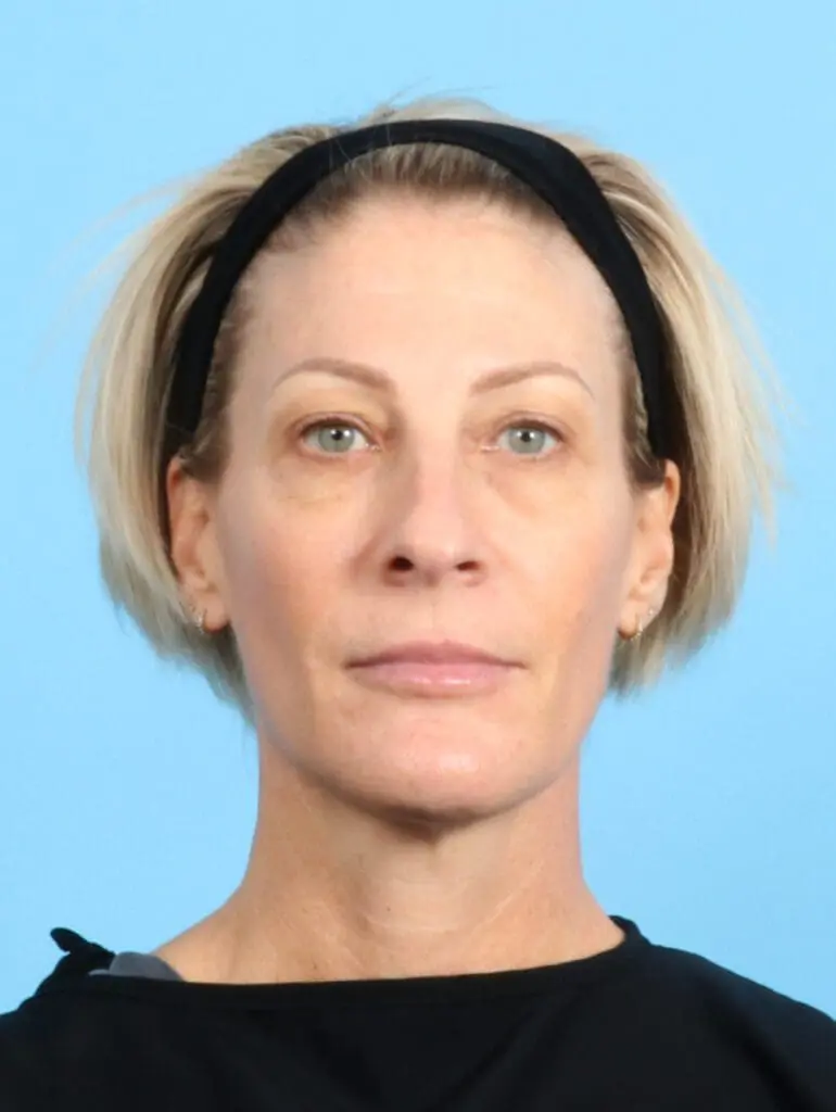 Eyelid Surgery - Case 22131 - Before