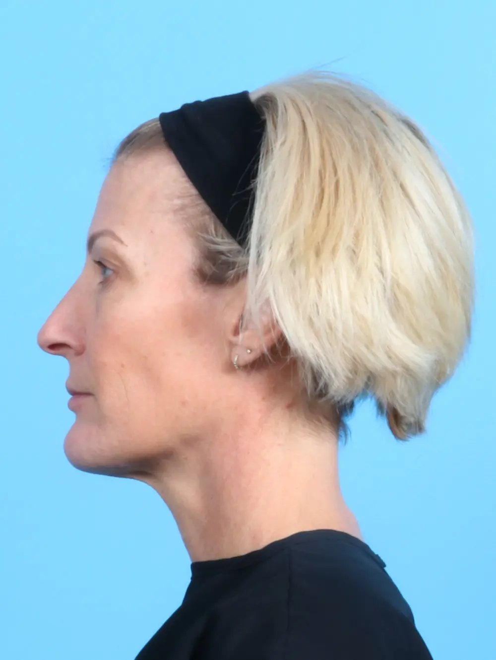 Eyelid Surgery Patient Photo - Case 22131 - before view-2