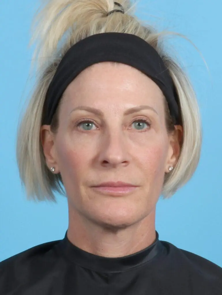 Eyelid Surgery - Case 22131 - After