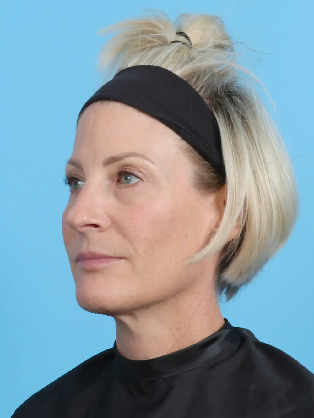 Eyelid Surgery Patient Photo - Case 22131 - after view-1