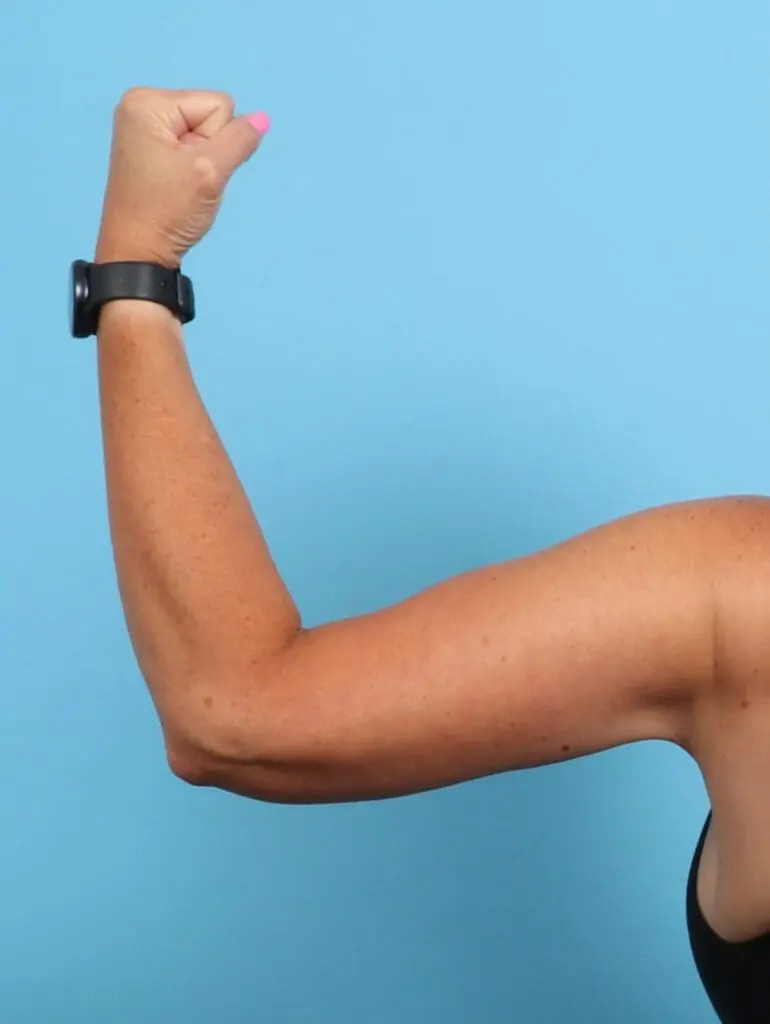 Arm Lift - Case 22161 - After