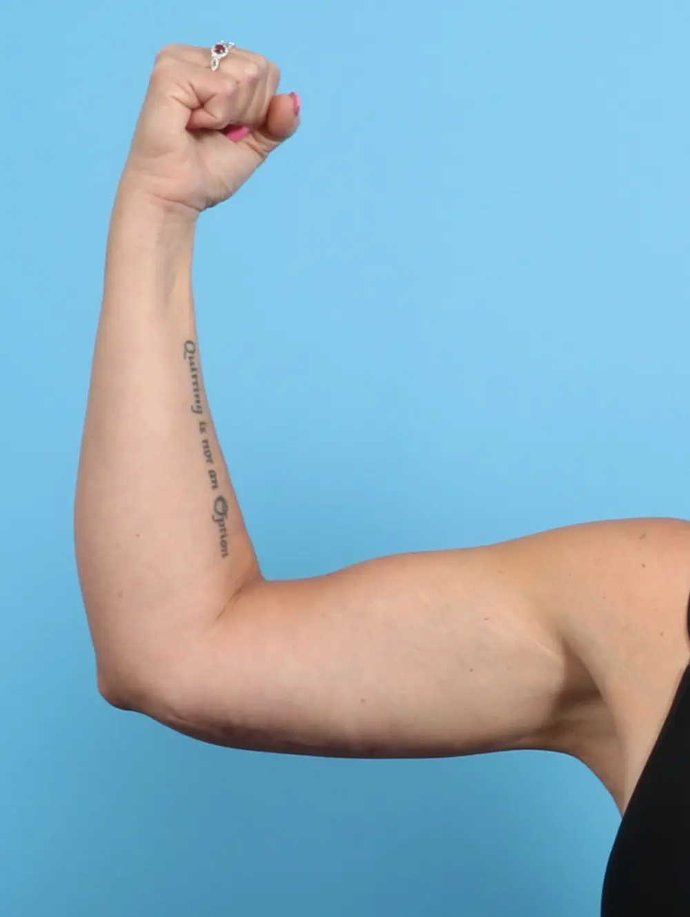 Arm Lift Patient Photo - Case 22161 - after view-1