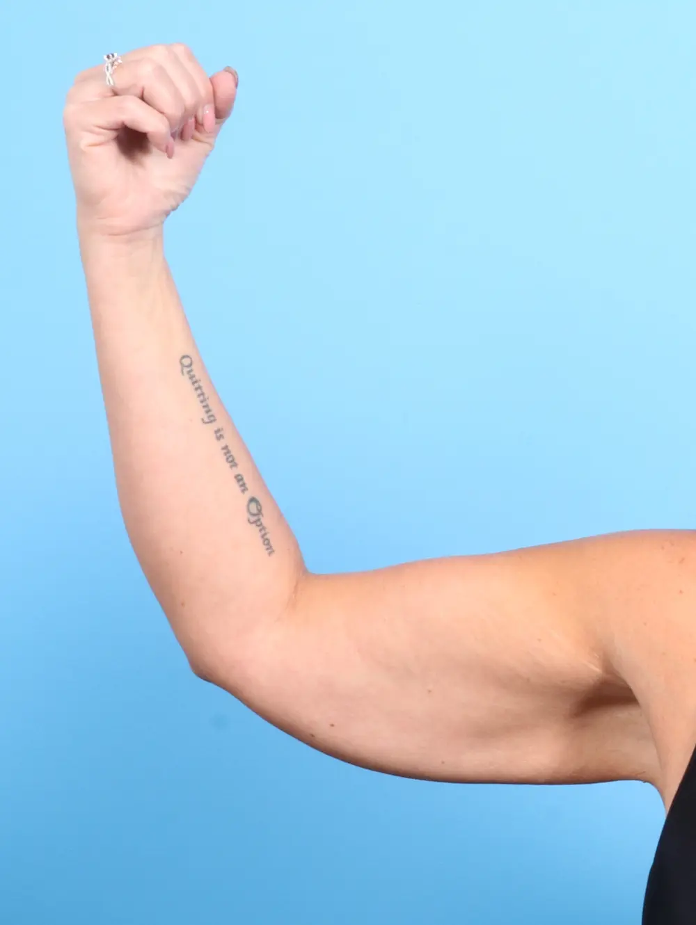 Arm Lift Patient Photo - Case 22161 - before view-1