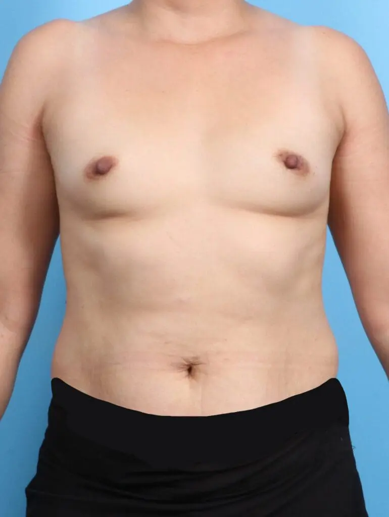 Breast Augmentation - Case 22213 - Before