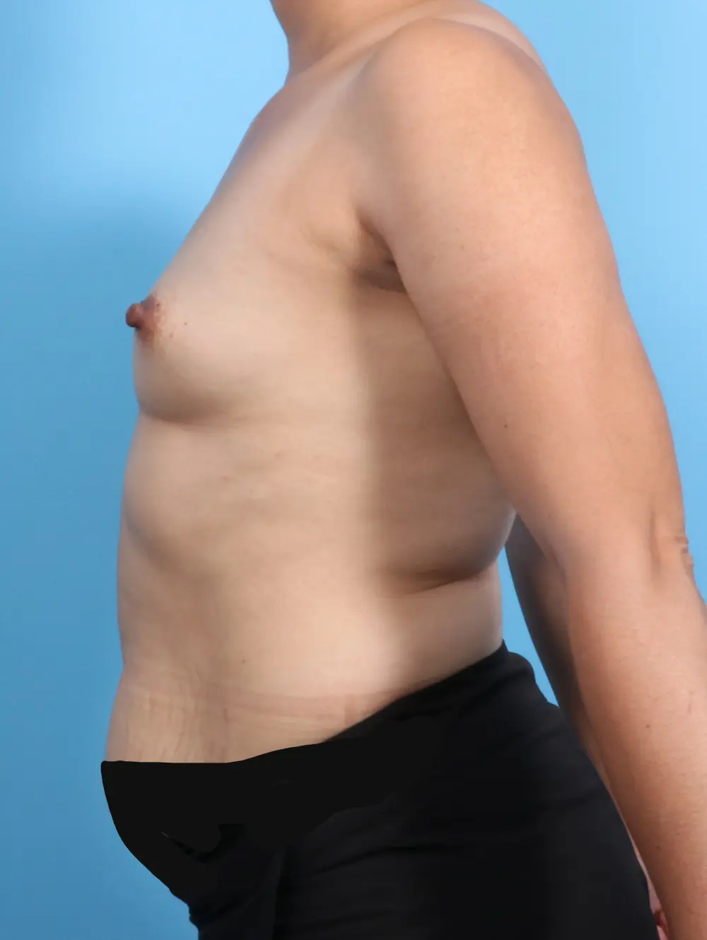 Breast Augmentation Patient Photo - Case 22213 - before view-2