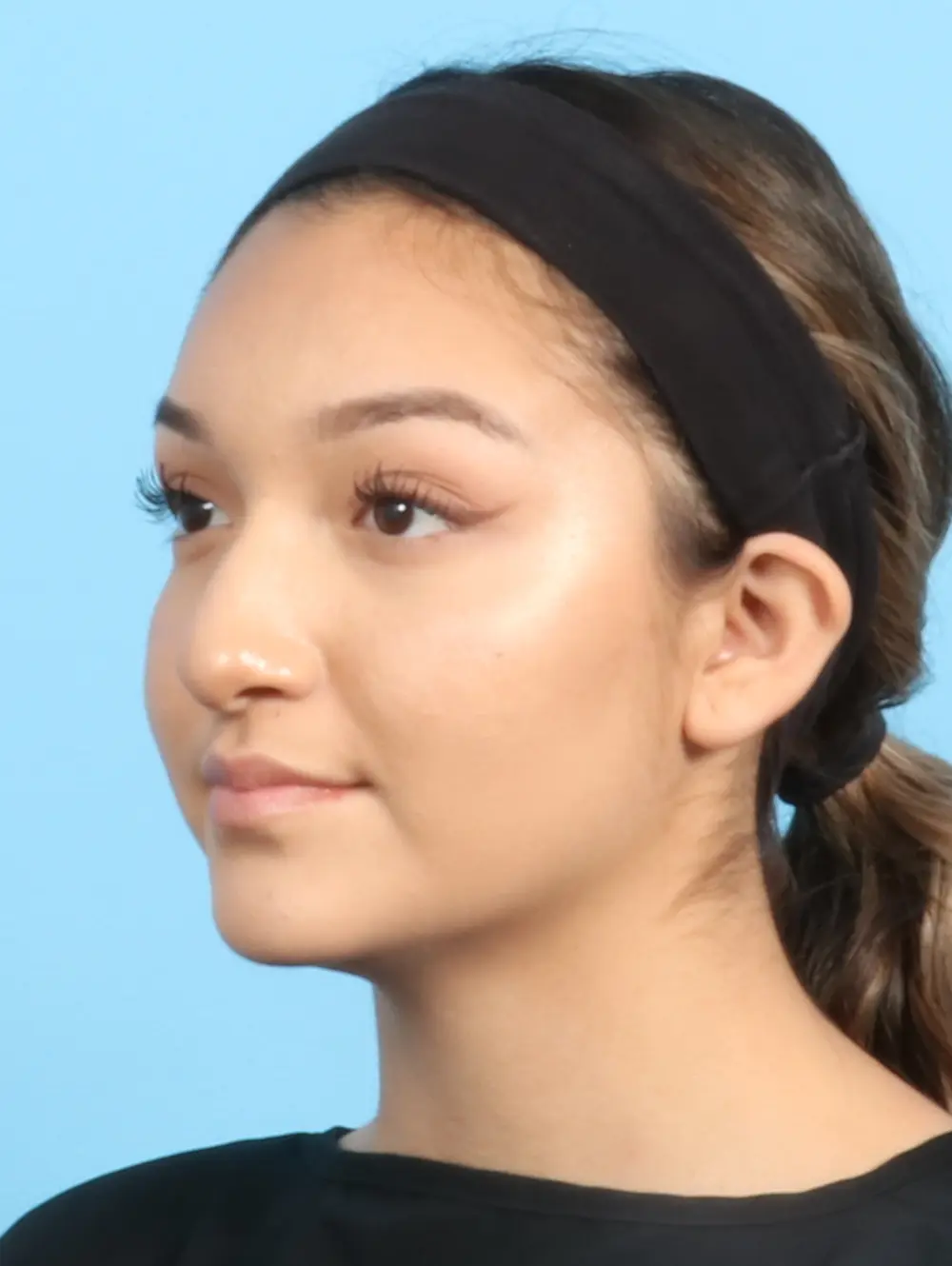 Rhinoplasty Patient Photo - Case 22262 - before view-2