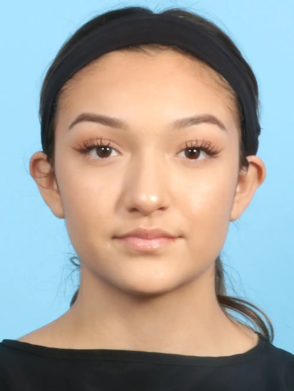 Rhinoplasty Patient Photo - Case 22262 - before view-1