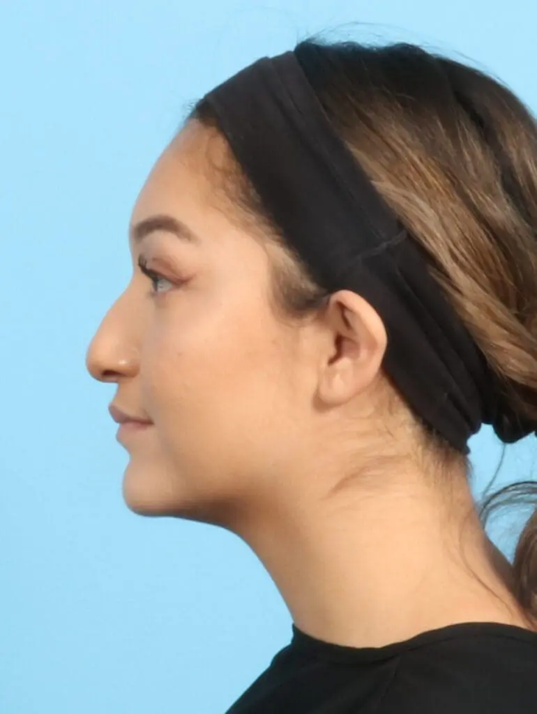 Rhinoplasty - Case 22262 - Before