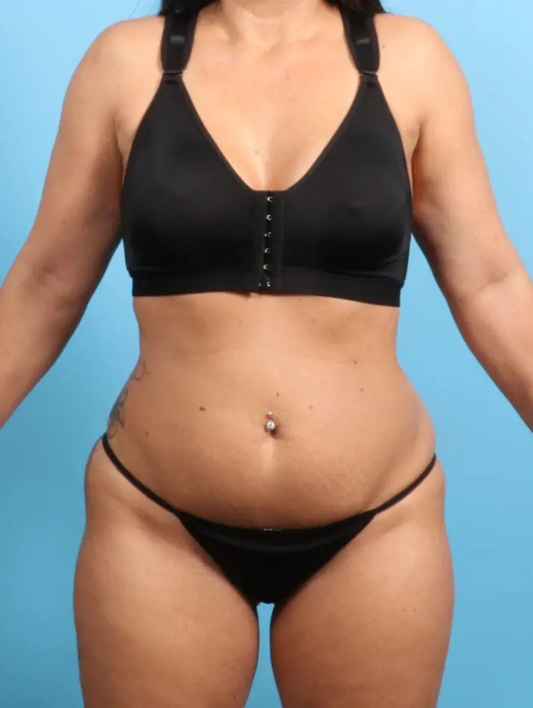 Tummy Tuck - Case 22270 - Before