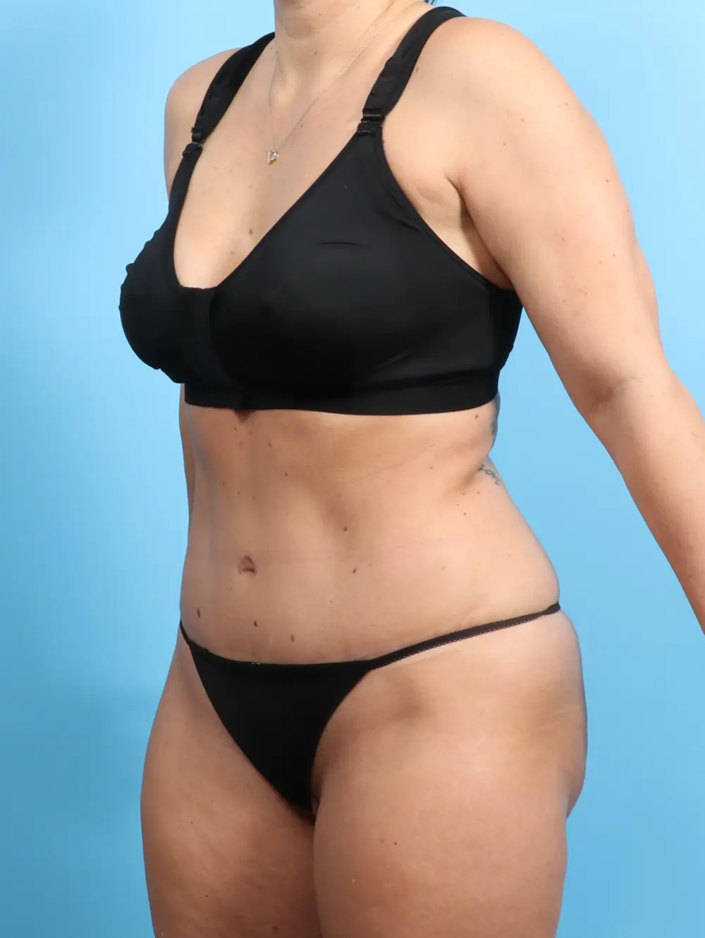 Tummy Tuck Patient Photo - Case 22270 - after view-1