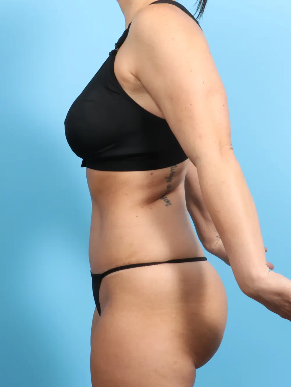 Tummy Tuck Patient Photo - Case 22270 - after view-2