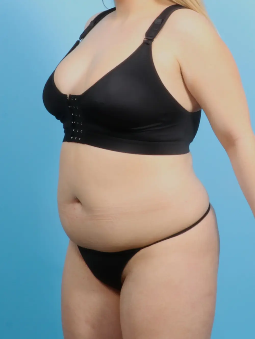 Liposuction Patient Photo - Case 22311 - before view-1