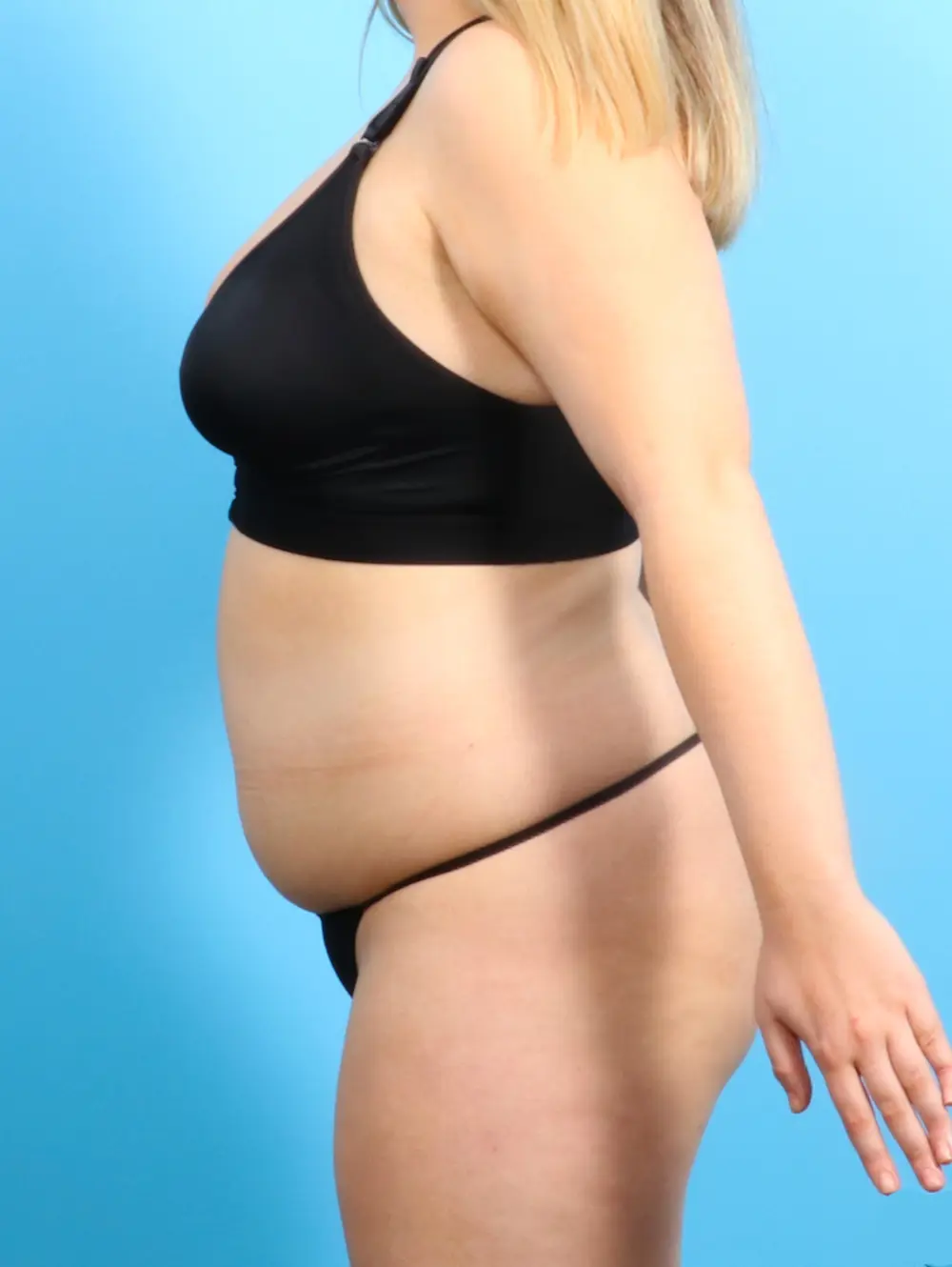Liposuction Patient Photo - Case 22311 - before view-2
