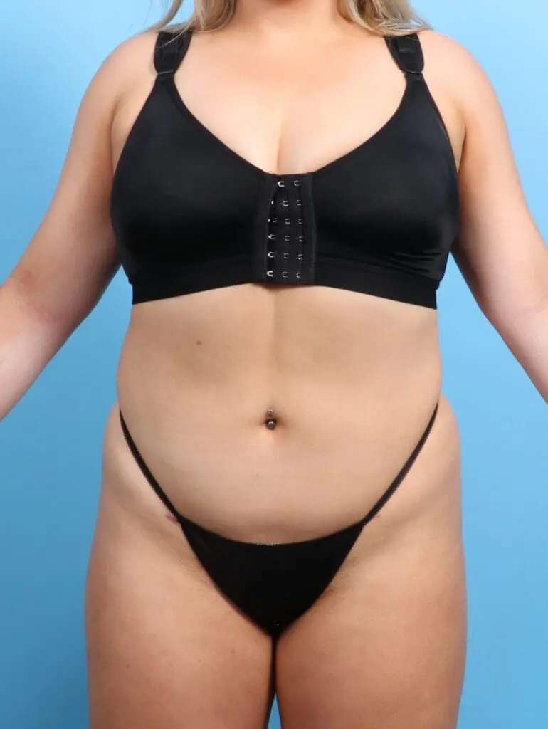 Liposuction - Case 22311 - After