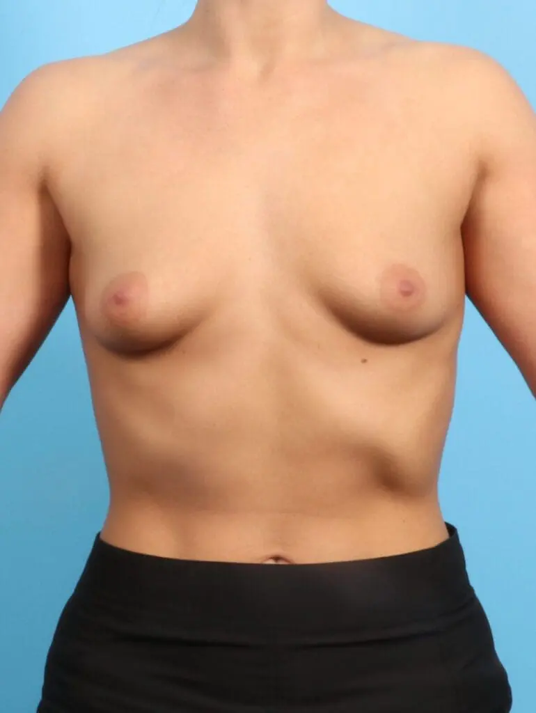 Breast Augmentation - Case 22319 - Before