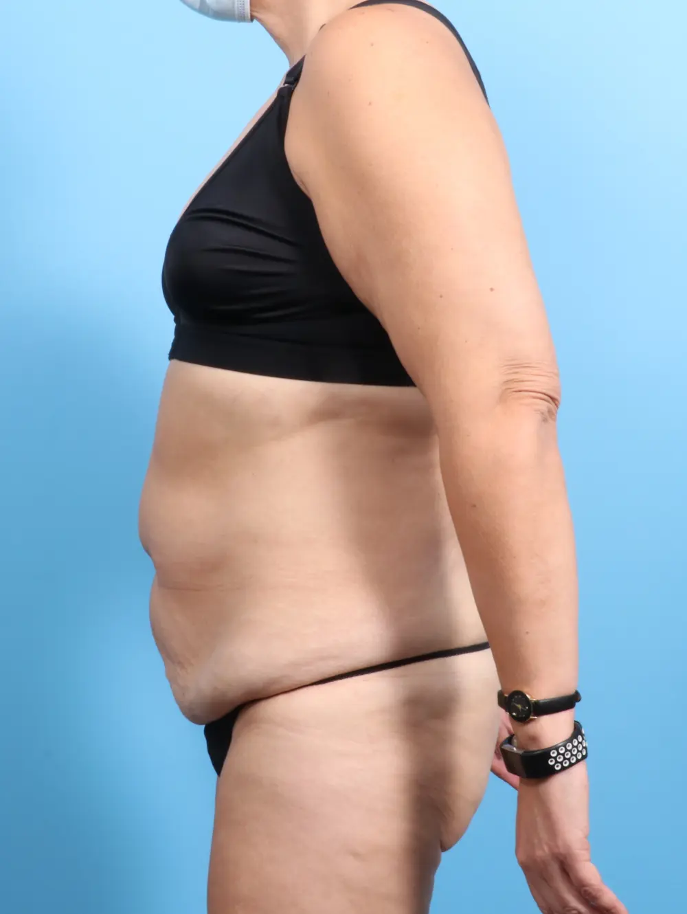 Tummy Tuck Patient Photo - Case 22328 - before view-2