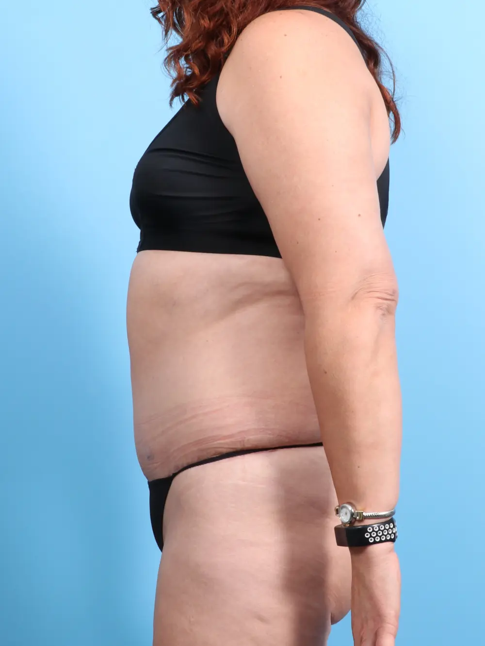 Tummy Tuck Patient Photo - Case 22328 - after view-2