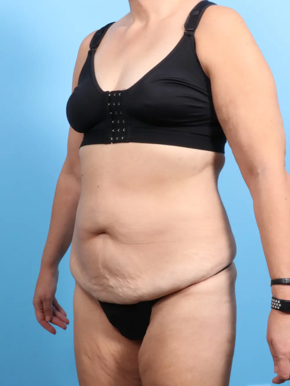 Tummy Tuck Patient Photo - Case 22328 - before view-1