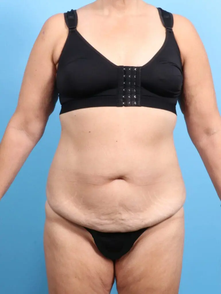 Tummy Tuck - Case 22328 - Before