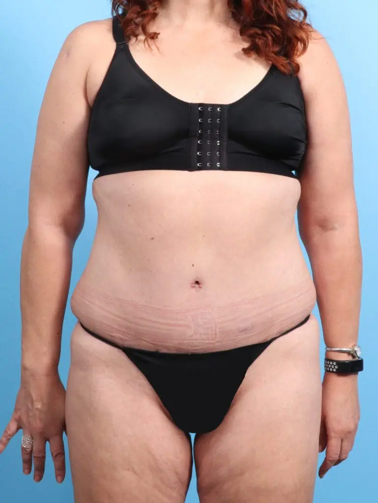 Tummy Tuck - Case 22328 - After