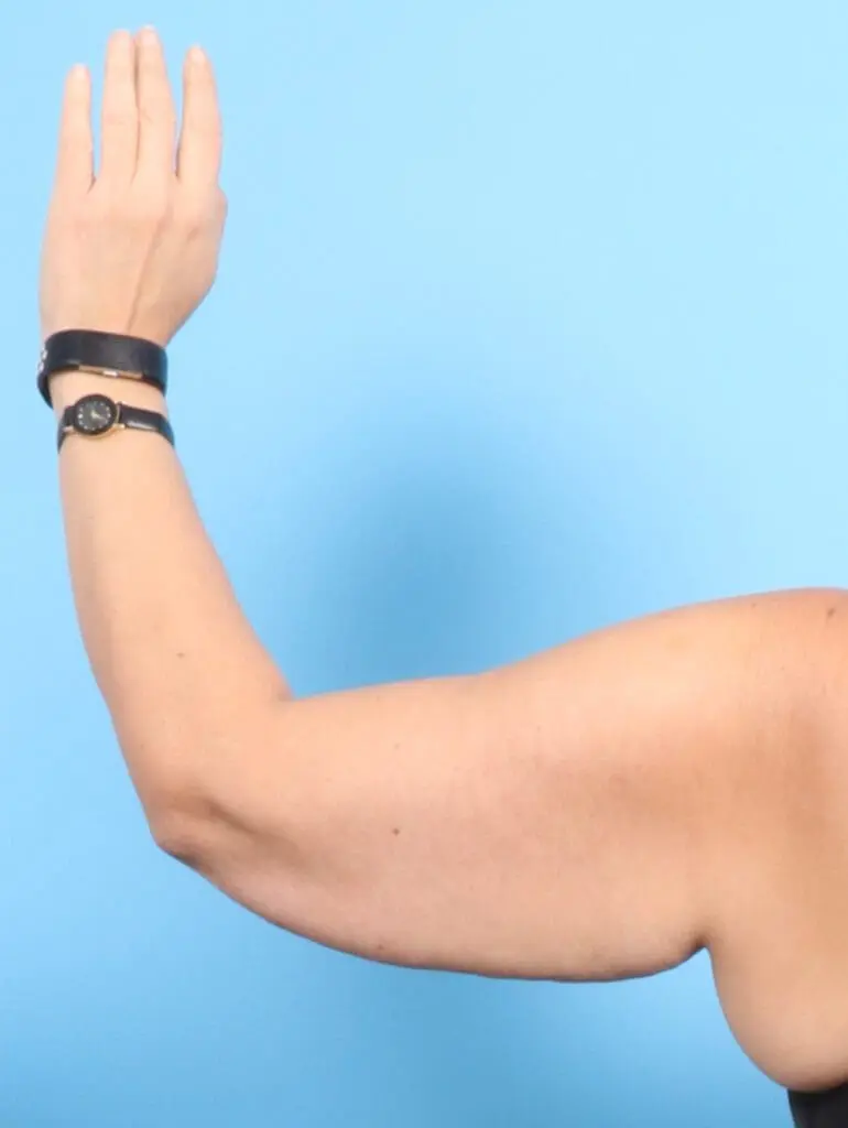 Arm Lift - Case 22336 - Before