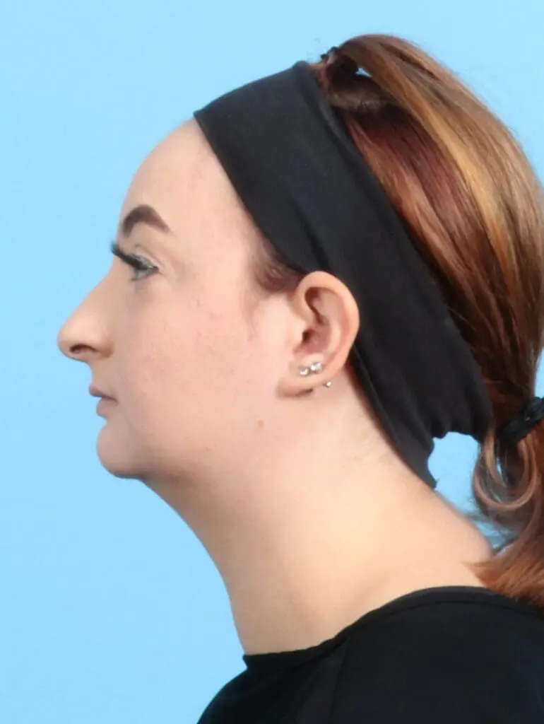 Chin Implant - Case 22346 - Before