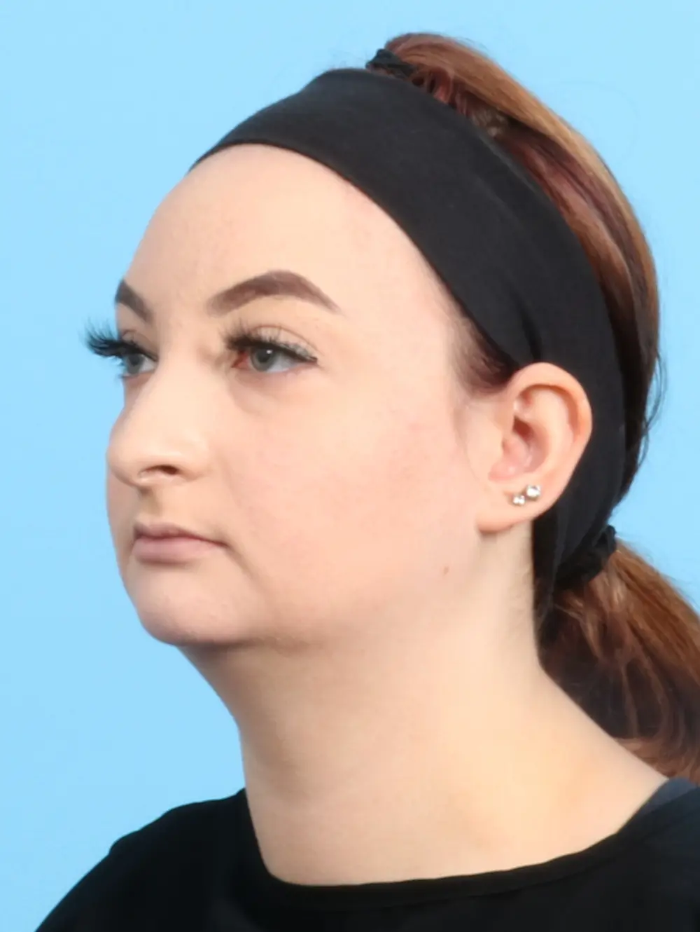 Chin Implant Patient Photo - Case 22346 - before view-1