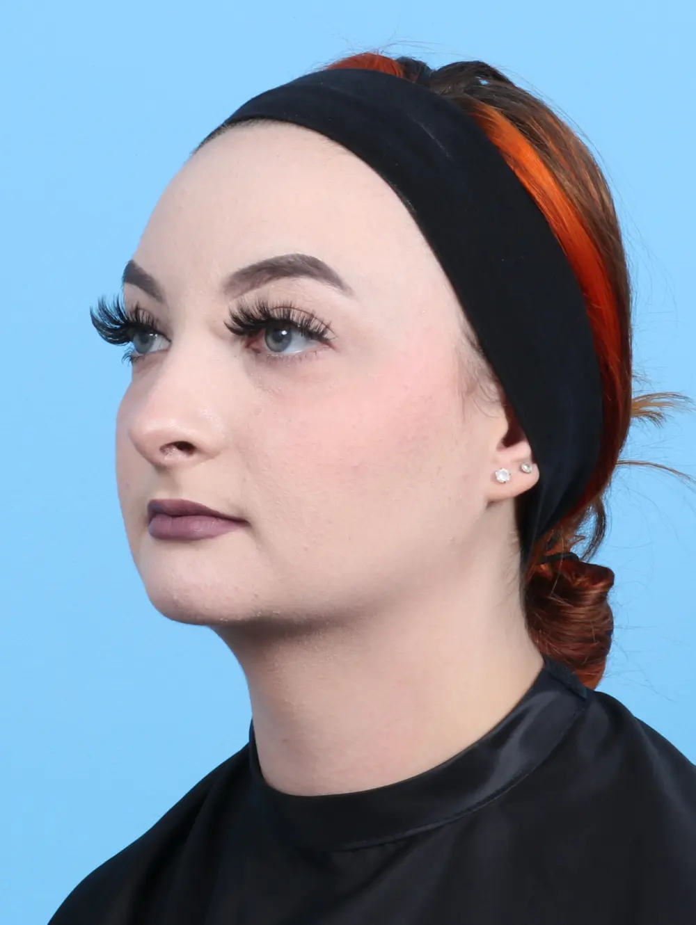 Chin Implant Patient Photo - Case 22346 - after view-1